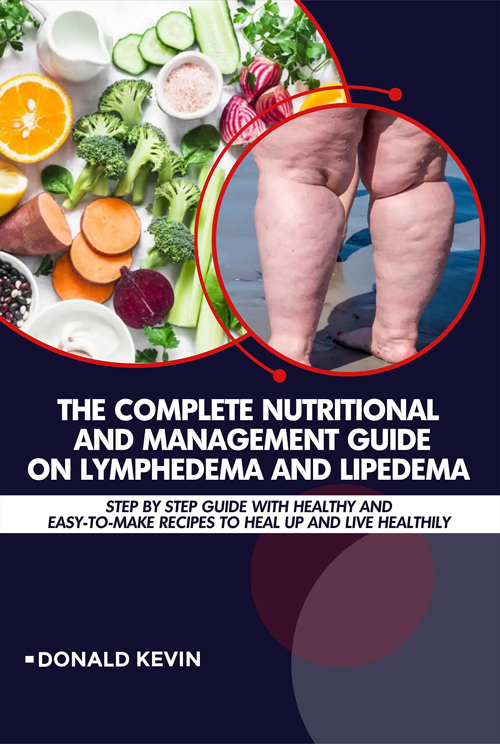 The Complete Nutritional and Management Guide on Lymphedema and