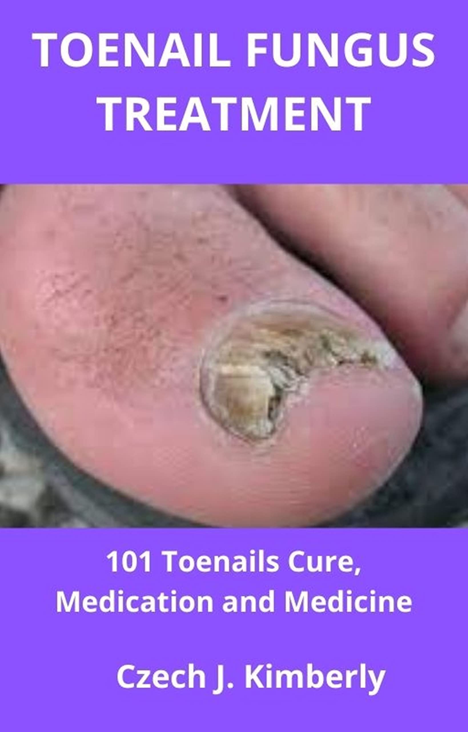 TOENAIL FUNGUS TREATMENT 101 Toenails Cure, Medication and Medicine by