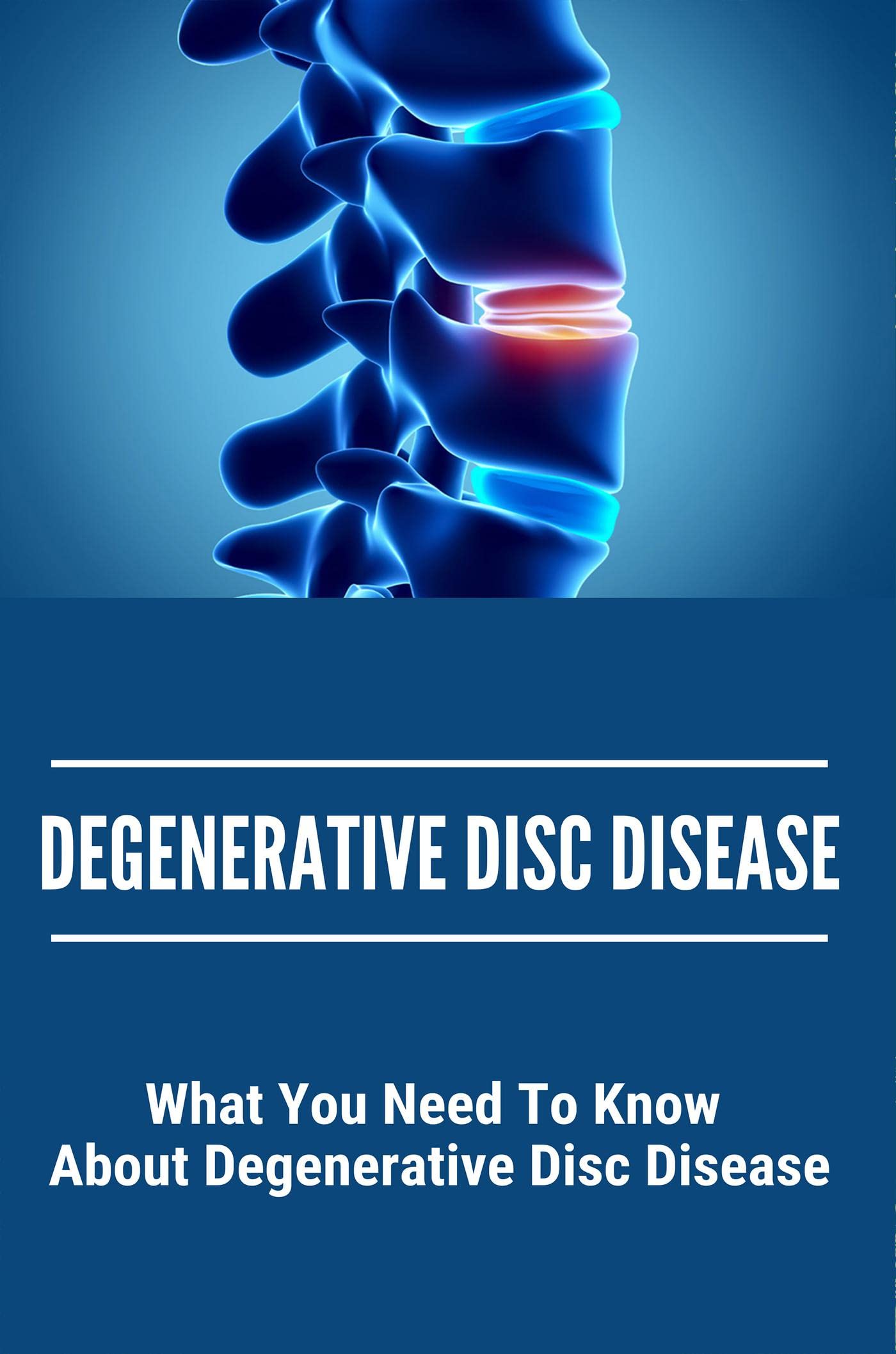 Degenerative Disc Disease What You Need To Know About Degenerative Disc Disease by Royce Ralat