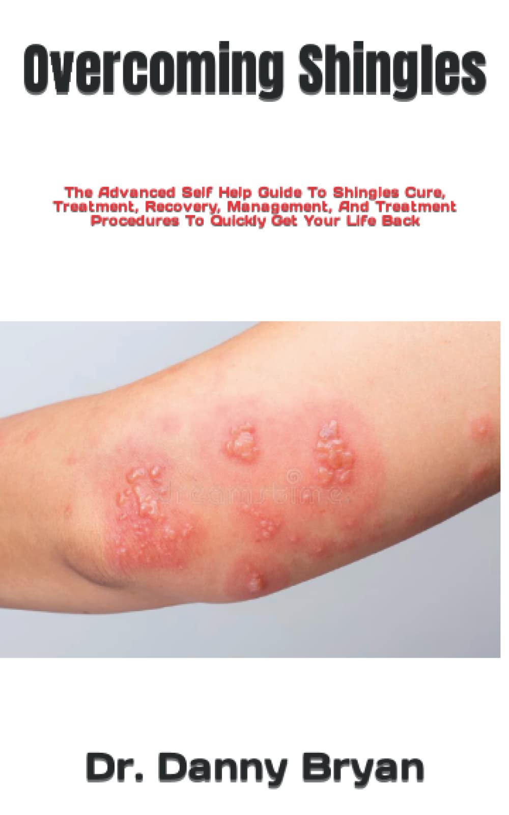 Shingles The Advanced Self Help Guide To Shingles Cure