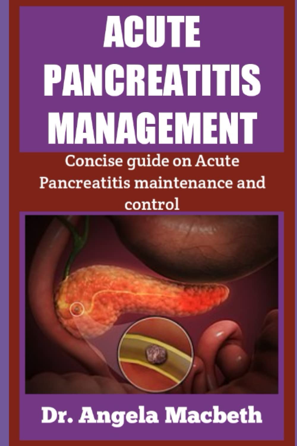 ACUTE PANCREATITIS MANAGEMENT Concise Guide on Acute Pancreatitis