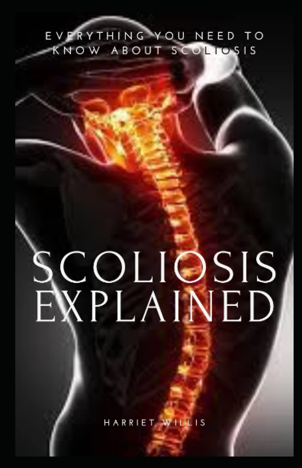SCOLIOSIS EXPLAINED EVERYTHING YOU NEED TO KNOW ABOUT SCOLIOSIS by