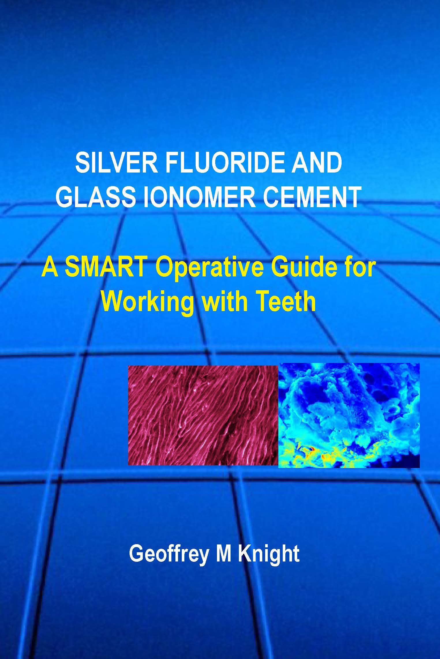 Silver Fluoride and Glass Ionomer Cement A SMART Operative Guide For