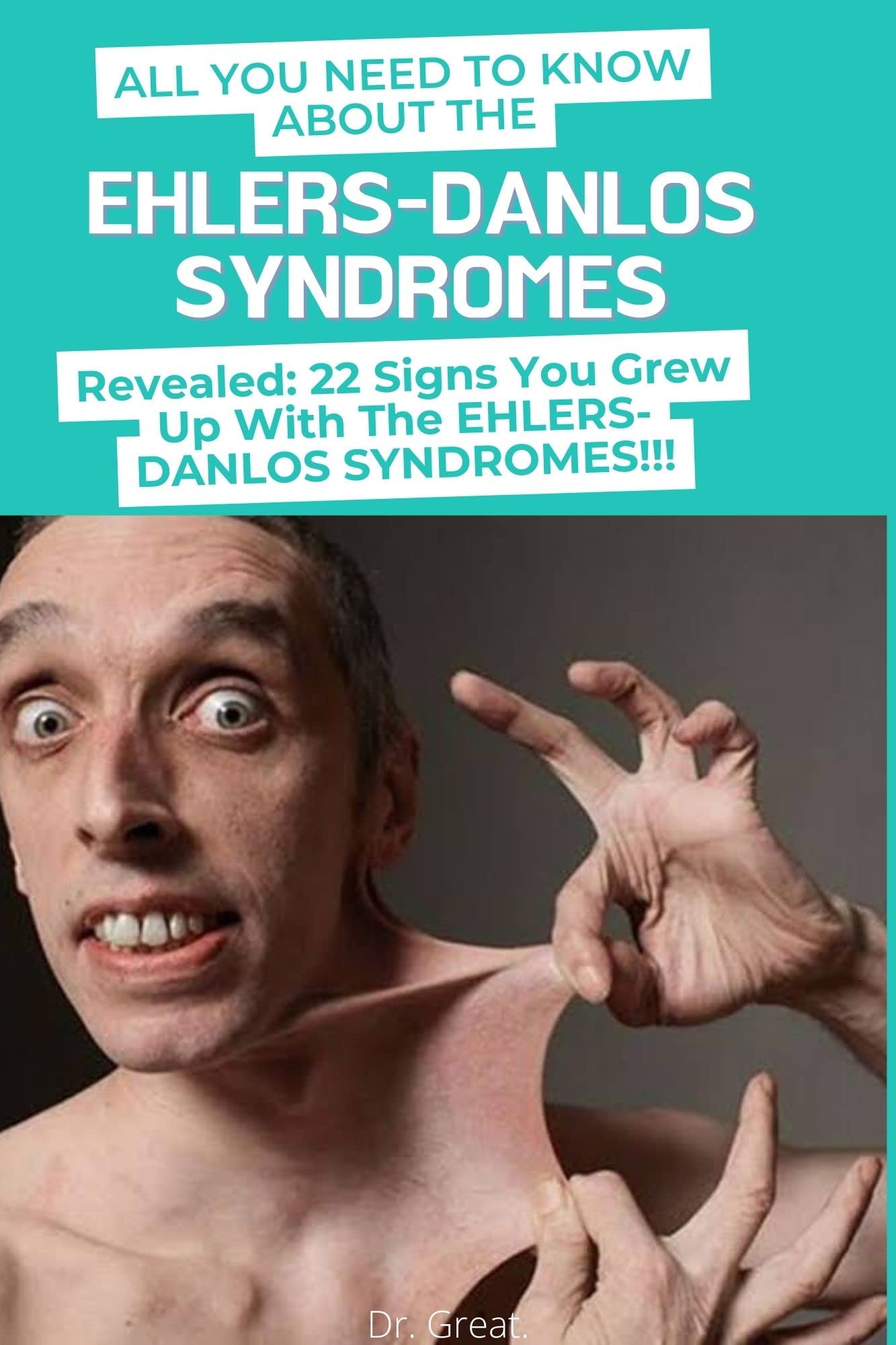 ALL YOU NEED TO KNOW ABOUT THE EHLERSDANLOS SYNDROMES Revealed 22