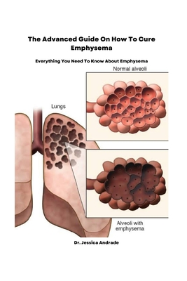 The Advanced Guide On How To Cure Emphysema: Everything You Need To
