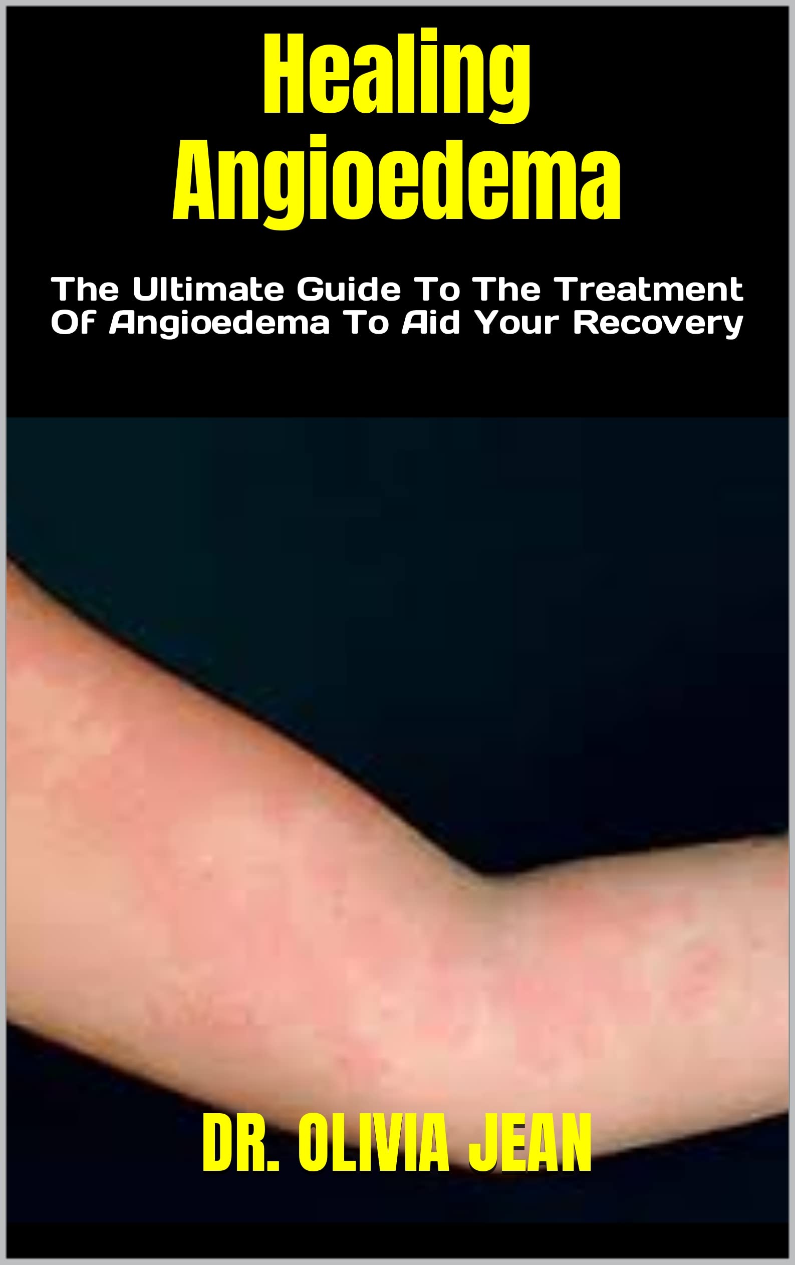 Angioedema: Overview And More: Angioödem Gesicht – WKNPQ