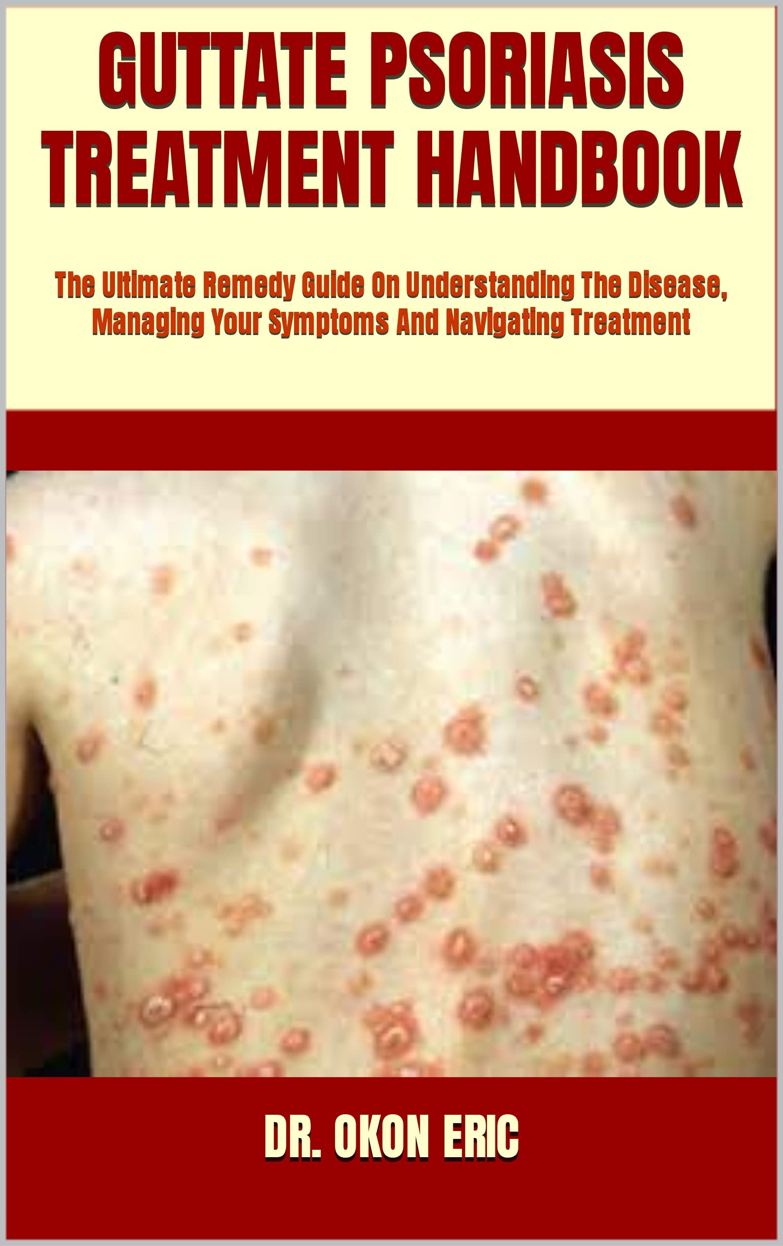 GUTTATE PSORIASIS TREATMENT HANDBOOK The Ultimate Remedy Guide On