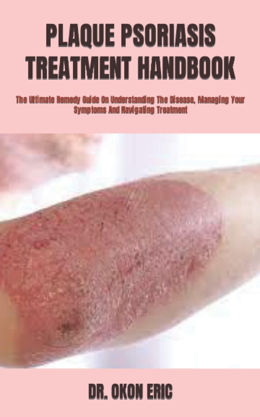 PLAQUE PSORIASIS TREATMENT HANDBOOK The Ultimate Remedy Guide On