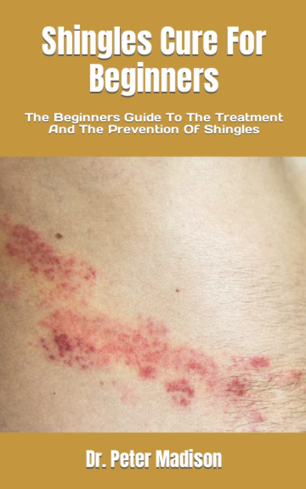 Shingles Cure For Beginners The Beginners Guide To The Treatment And