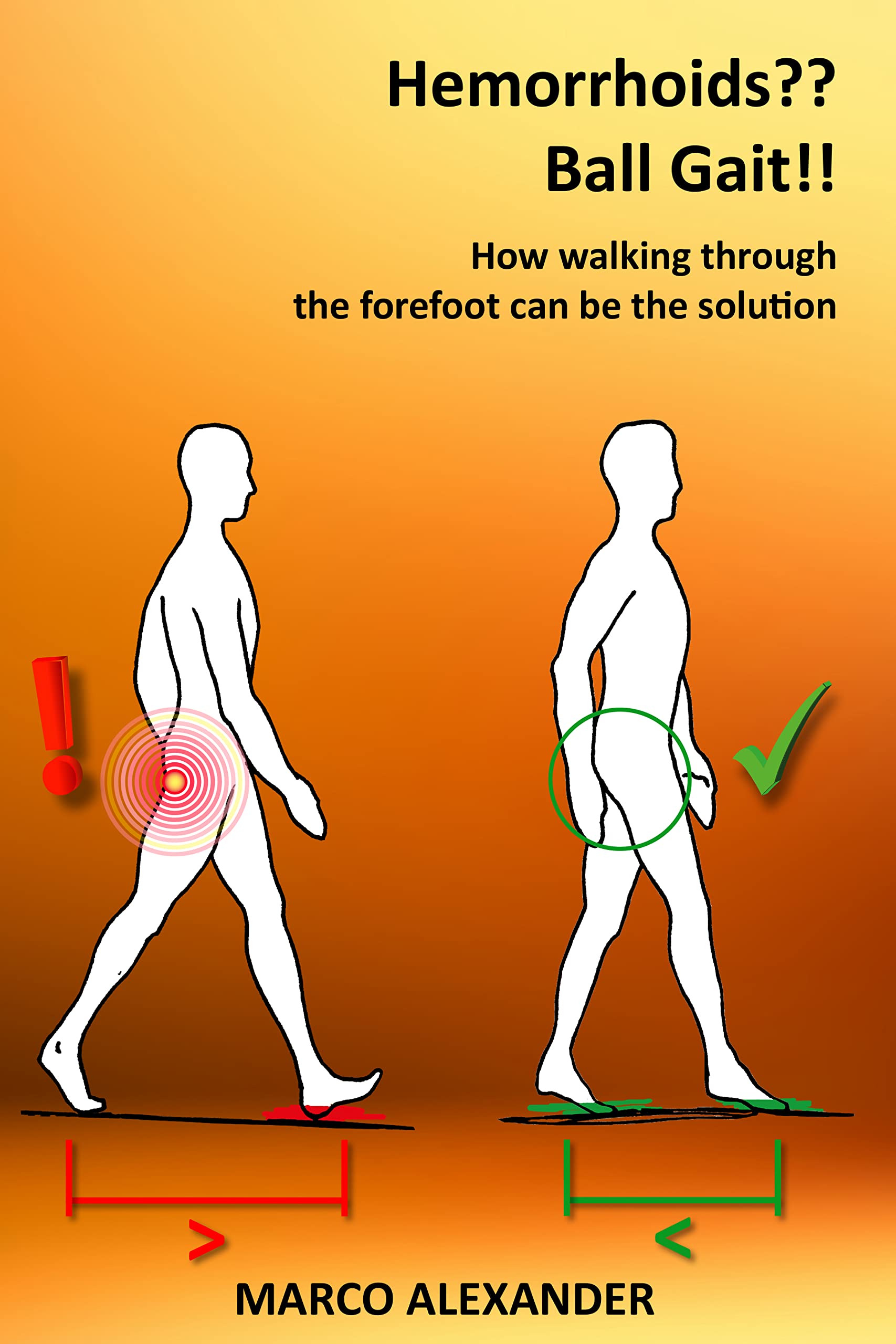 Hemorrhoids?? Ball Gait!! How walking through the forefoot can be the