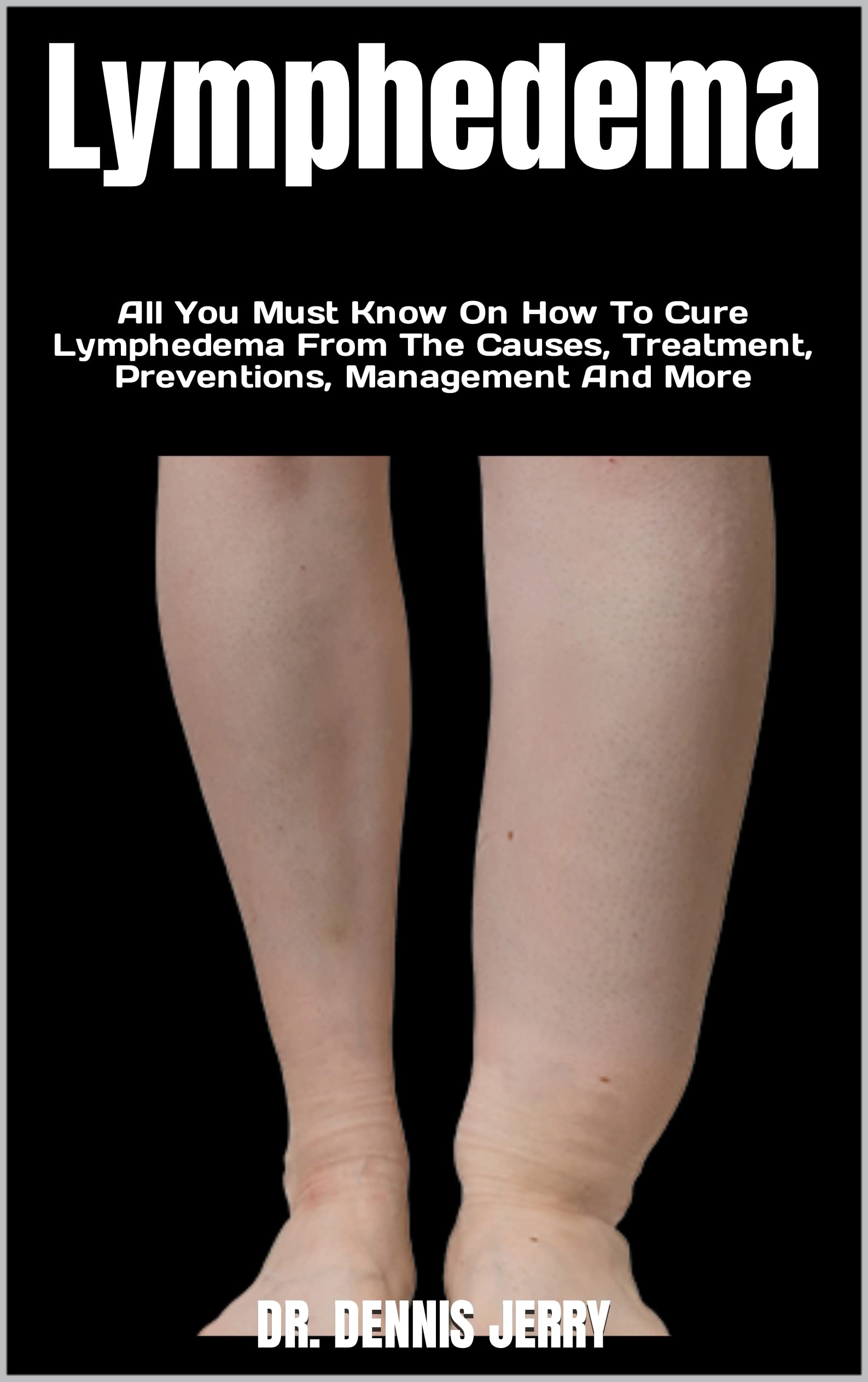 Lymphedema All You Must Know On How To Cure Lymphedema From The