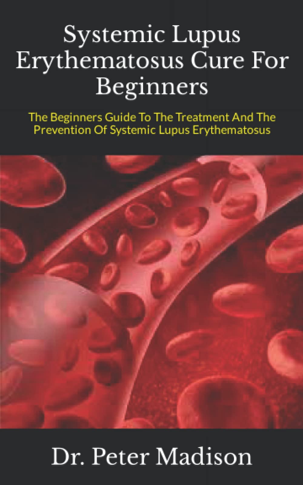 Systemic Lupus Erythematosus Cure For Beginners The Beginners Guide To The Treatment And The