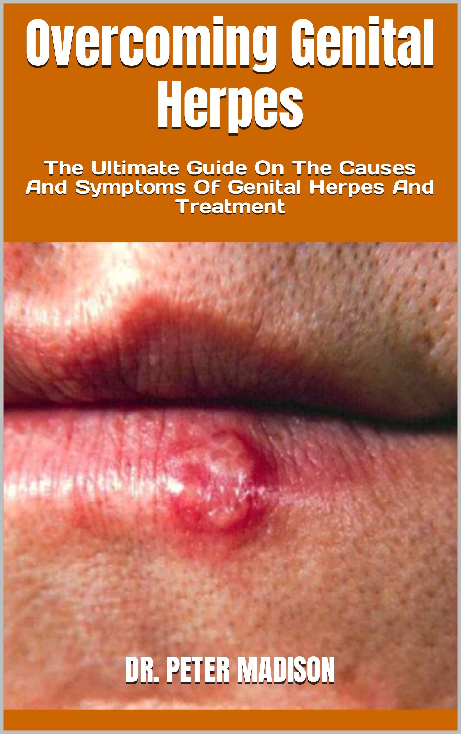 Overcoming Genital Herpes The Ultimate Guide On The Causes And 