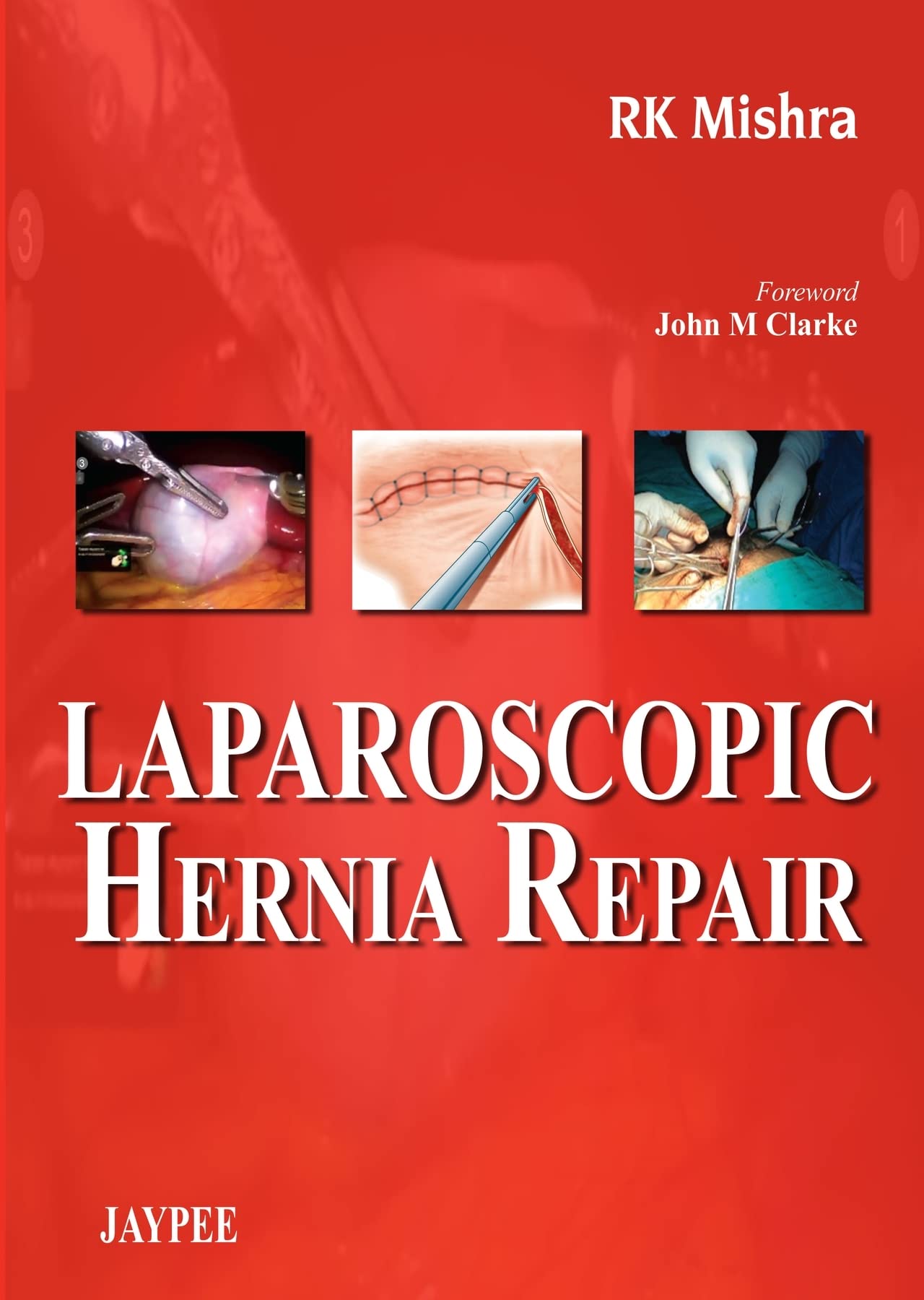 Laparoscopic Hernia Repair by RK Mishra Goodreads