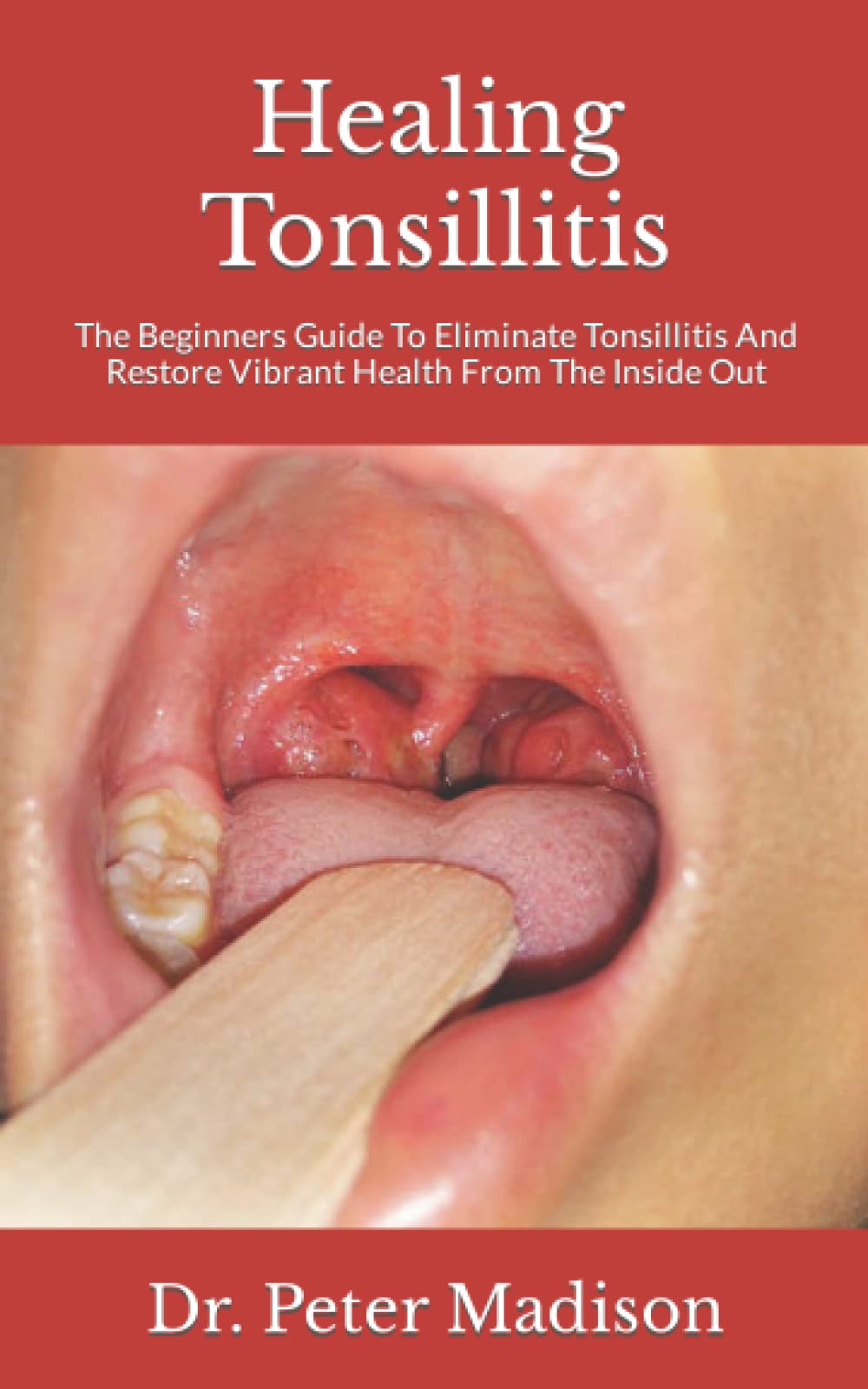 Healing Tonsillitis The Beginners Guide To Eliminate Tonsillitis And