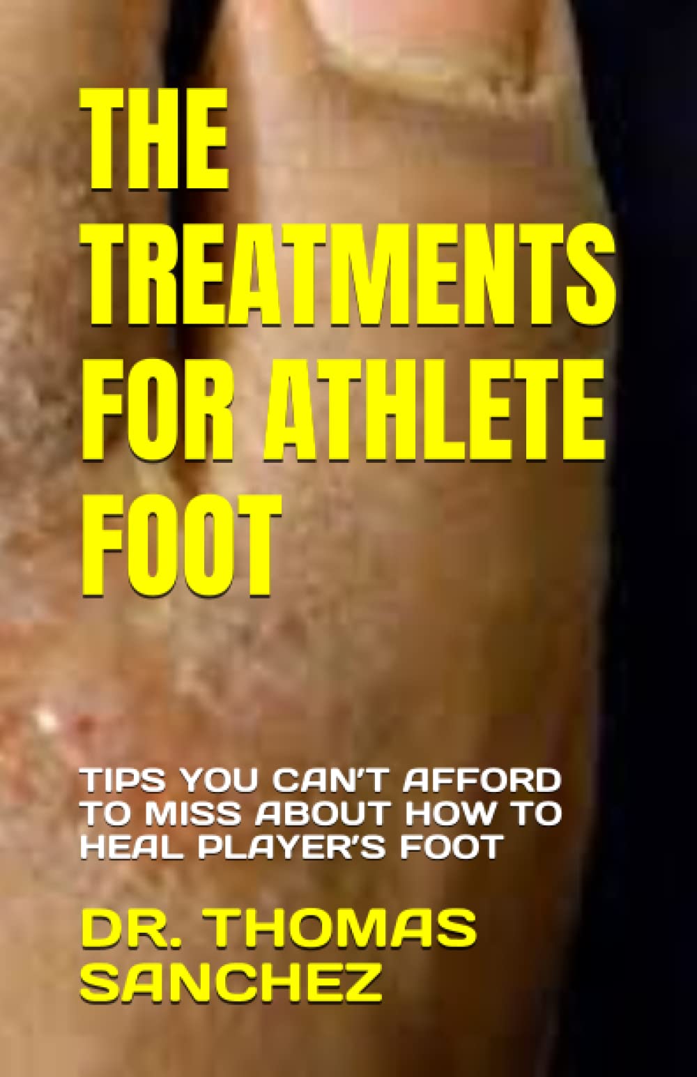 THE TREATMENTS FOR ATHLETE FOOT TIPS YOU CAN’T AFFORD TO MISS ABOUT