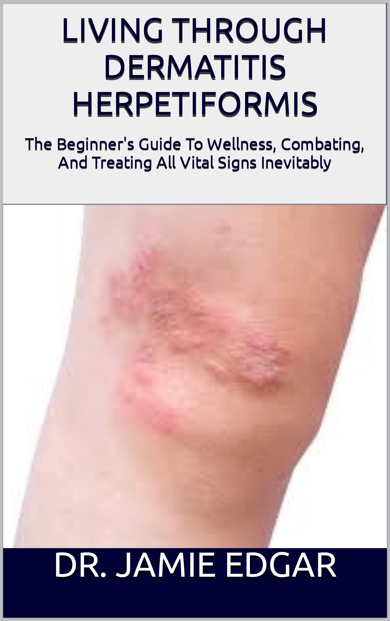 LIVING THROUGH DERMATITIS HERPETIFORMIS The Beginner's Guide To