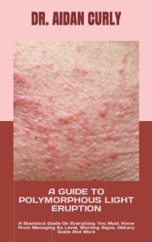 A GUIDE TO POLYMORPHOUS LIGHT ERUPTION: A Standard Guide On Everything ...