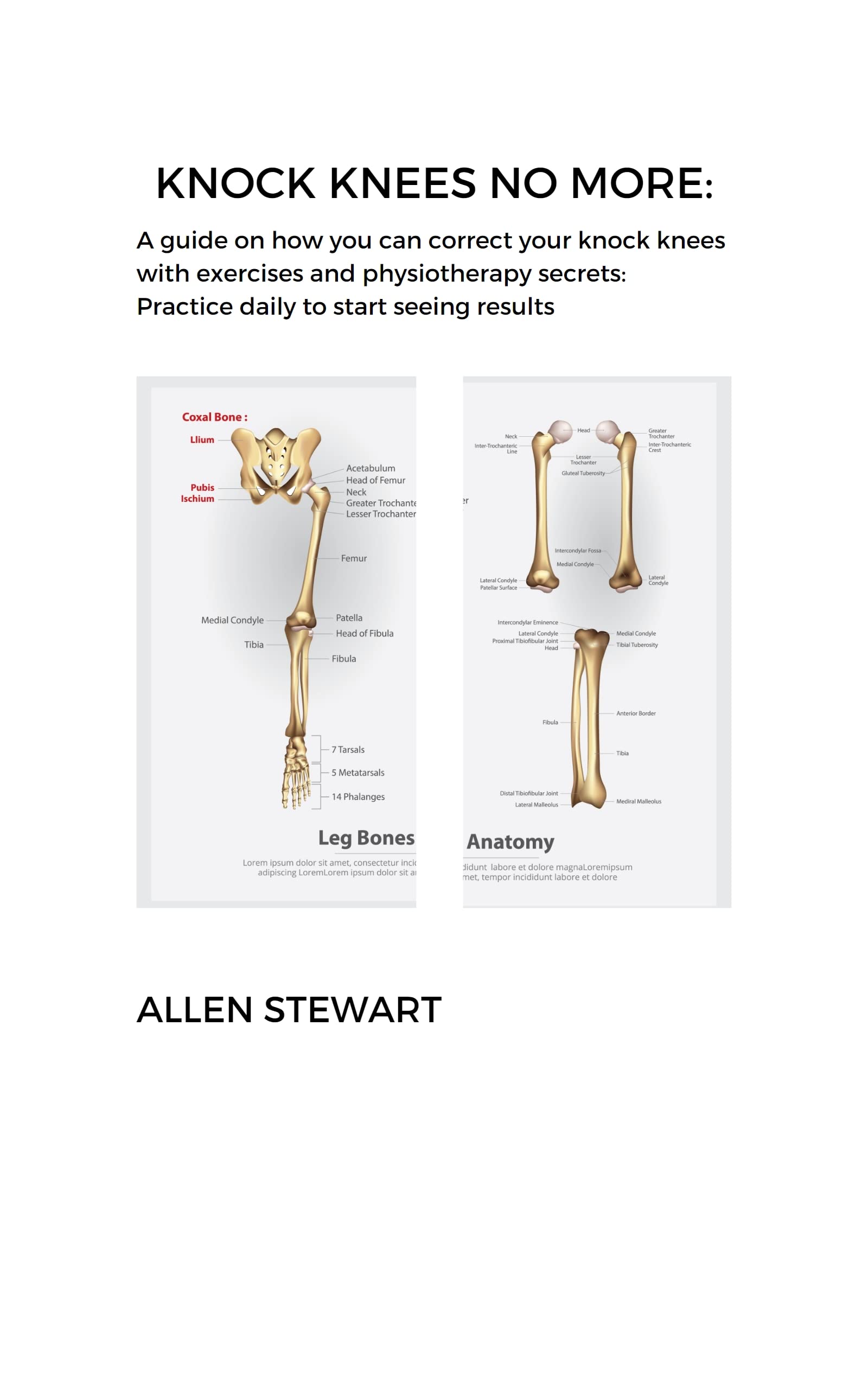 Knock Knees No More A guide on how you can correct your knock knees