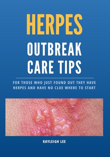 HERPES Outbreak Care Tips - Living With Herpes - HSV 1 & HSV 2 ...